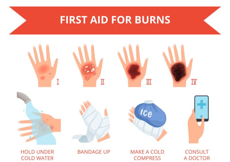 biện pháp sơ cứu người bỏng