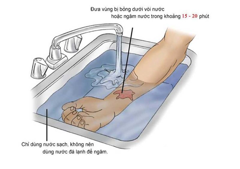 biện pháp sơ cứu người bỏng