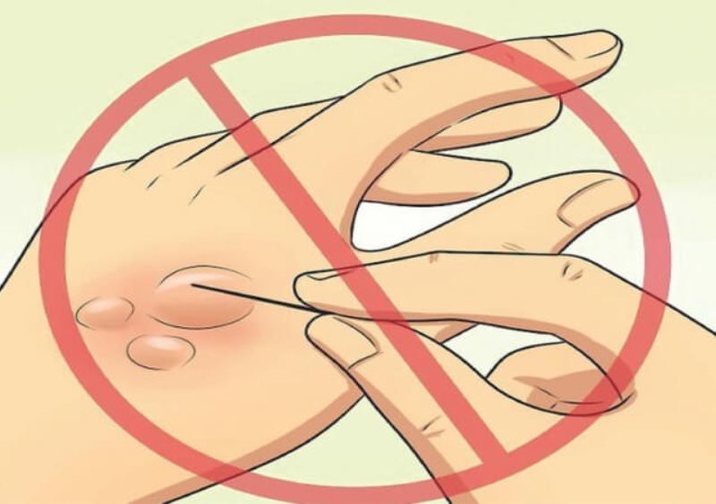 biện pháp sơ cứu người bỏng