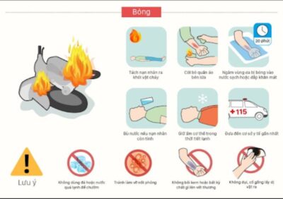 biện pháp sơ cứu người bỏng